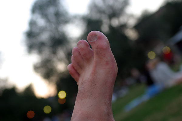 "Pete's Foot on the Common"